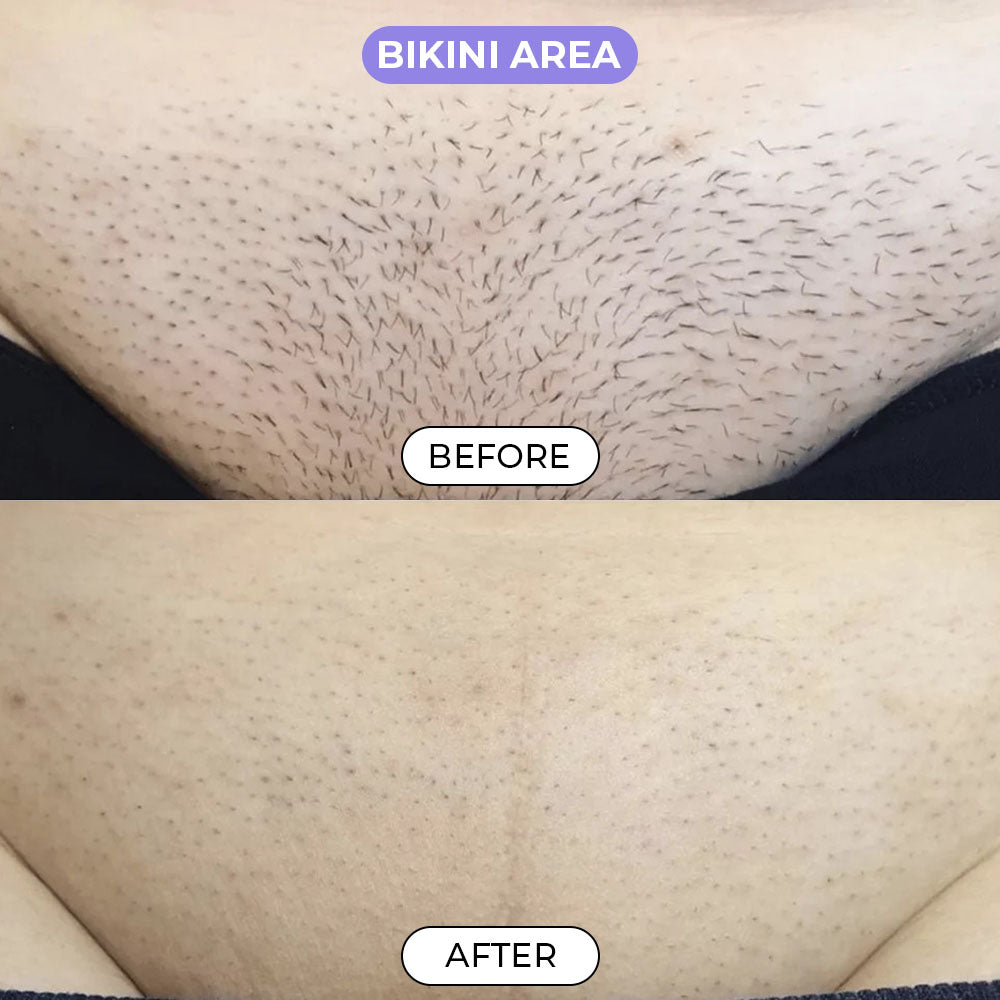 Body Hair Removal Cream